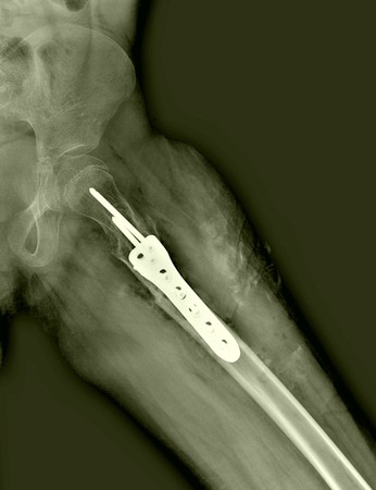 radiograph proximal femur fractureの写真素材