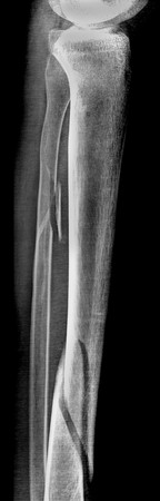 radiography with oblique fibula fractureの写真素材