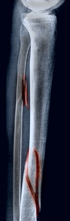 radiography with oblique fibula fractureの写真素材