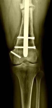 femur distal fractureの写真素材