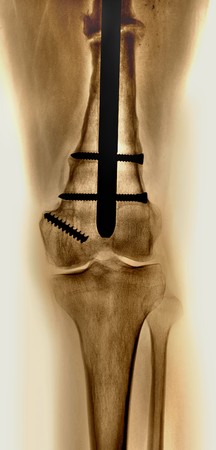 femur distal fractureの写真素材