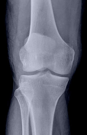 X-ray image of the knee joint of a young man.