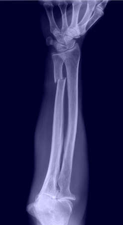 X-ray of human hand isolated on dark blue background, medical conceptの写真素材