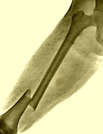 x-ray femur fractureの写真素材