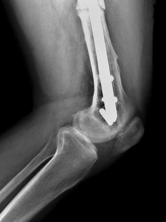 X-ray of the knee joint. Image of the knee joint.の写真素材