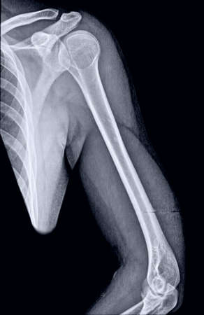 X-ray of the shoulder and elbow of a young man.の写真素材
