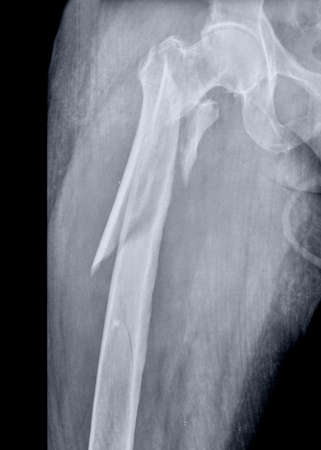 X-ray of the knee joint of a patient. Close-up.の写真素材
