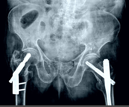 frontal x-ray bilateral hip replacementの写真素材