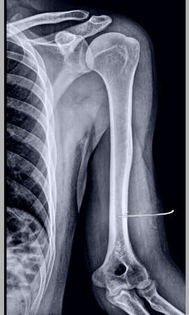 X-ray of the elbow of a person, close-upの写真素材