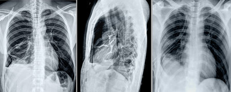 frontal and lateral chest x-ray with atelectasis and complicated pneumoniaの写真素材