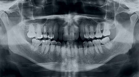 Dental x-ray image of the jaw, teeth and gums.の写真素材