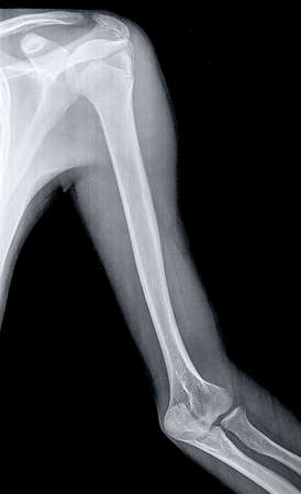 X-ray image of the elbow joint on a black background.の写真素材