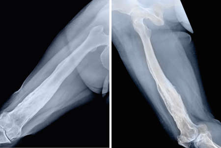 X-ray of a knee joint, both side and front view.の写真素材