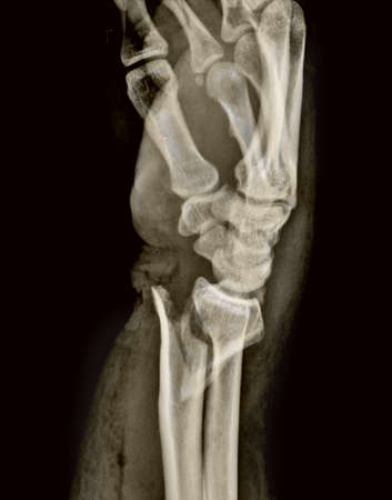 X-ray image of the knee joint, close-up viewの写真素材