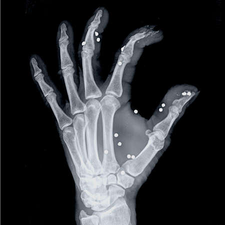 X-ray image of human hand. Isolated on black background.の写真素材