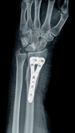 X-Ray image of human skeleton bones.の写真素材