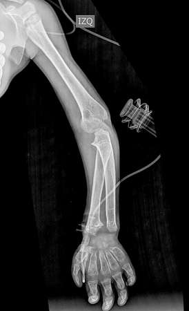 X-ray of human arm on black background, medical concept.の写真素材