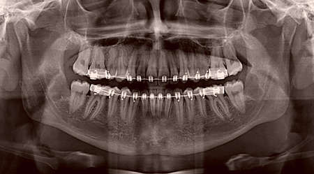 Dental x-ray image of human teeth with metal braces.の写真素材