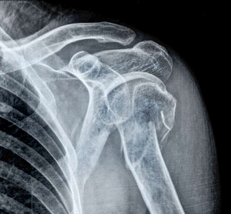 X-ray of human shoulder, side view, close-upの写真素材