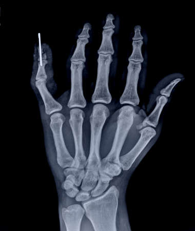 X-ray image of human hand and fingers, isolated on black backgroundの写真素材