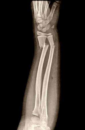 X-ray of the hand and arm of a man, black backgroundの写真素材