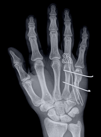 x-ray correction fracture of the phalanges of the handの写真素材