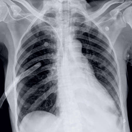 X-Ray image of human chest isolated on black background, close upの写真素材