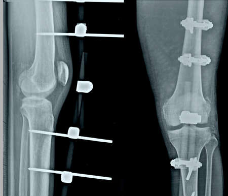 X-ray image of the knee joint of a male patient.の写真素材