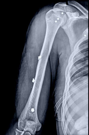 X-ray image of the knee joint of a female patient.の写真素材