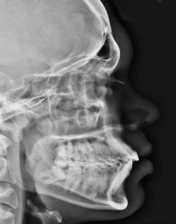 X-Ray image of human skull. Health care and medical concept.の写真素材