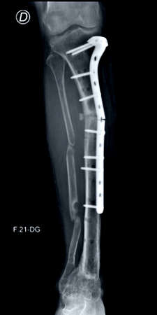 X-ray of the human knee joint. The skeleton of the knee is visible.の写真素材