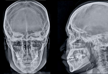 X-ray of the human skull. X-ray of the human skull.の写真素材