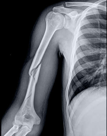 X-ray of the shoulder joint, close-up of the shoulderの写真素材