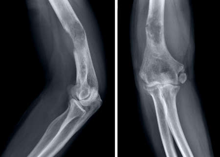 X-ray image of the human knee joint. The image is isolated on a black background.の写真素材