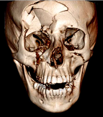tomography fracture facial bones 3D reconstructionsの写真素材