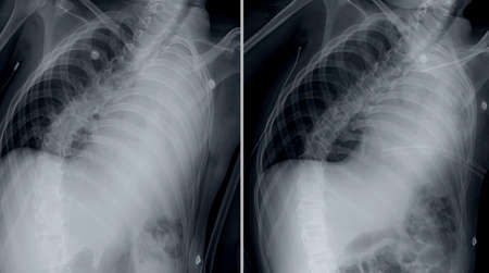 X-Ray image of human pelvis and thorax for medical diagnosis.の写真素材