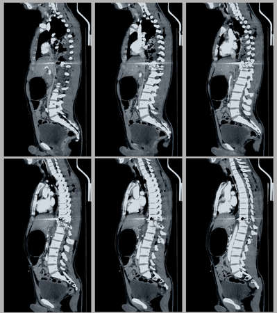 X-ray of the human spine. Medical diagnosis and treatment.の写真素材