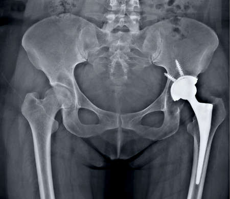 frontal x-ray fracture and hip replacement correctionの写真素材