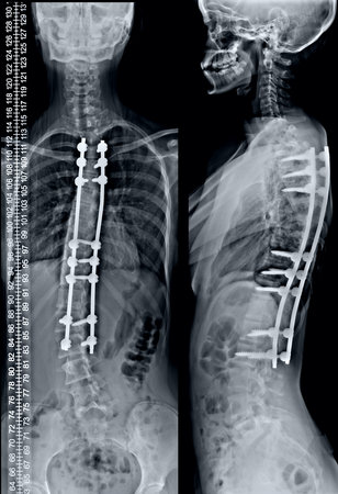 frontal and lateral x-ray correction of scoliosisの写真素材