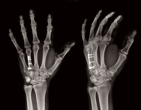 X-ray of human hand, x-ray image of skeletonの写真素材