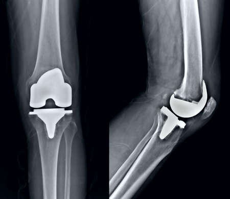 X-Ray image of the knee joint of a male patient.の写真素材