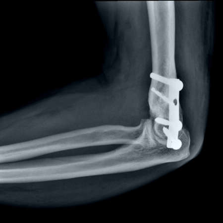 X-ray of the knee joint. Close-up image.