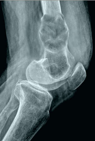 X-ray of the knee joint of a patient. Medical background.の写真素材