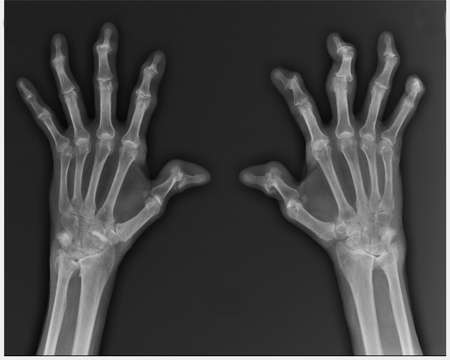 X-ray of human hand. Isolated on black background.の写真素材
