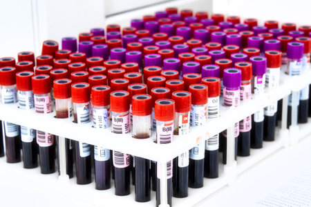 Numerous blood sample tubes with red and purple caps neatly organized in rows within a white holder,...