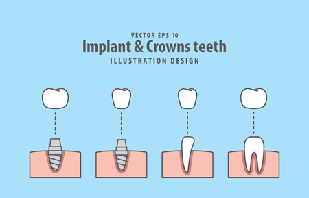 Implantのイラスト素材