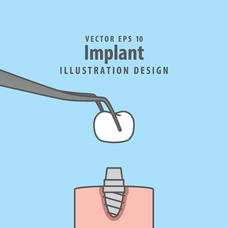 Implant illustration vector on blue background.のイラスト素材