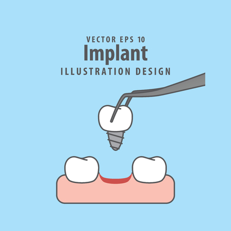 Implant illustration vector on blue background.のイラスト素材