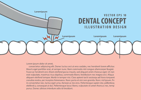 Layout decay tooth treatment (Caries) cartoon style for info or book illustration vector. Dental concept.のイラスト素材