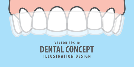 Banner Upper Essix retainer illustration vector on blue background. Dental concept.のイラスト素材